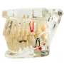 Training model for restorations with implants, transparent