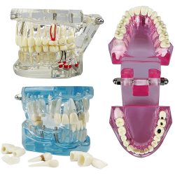 Training model for restorations with implants, blue-transparent